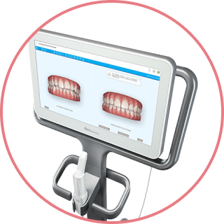 先進的機器iTero（口腔内スキャナー）で型取り！