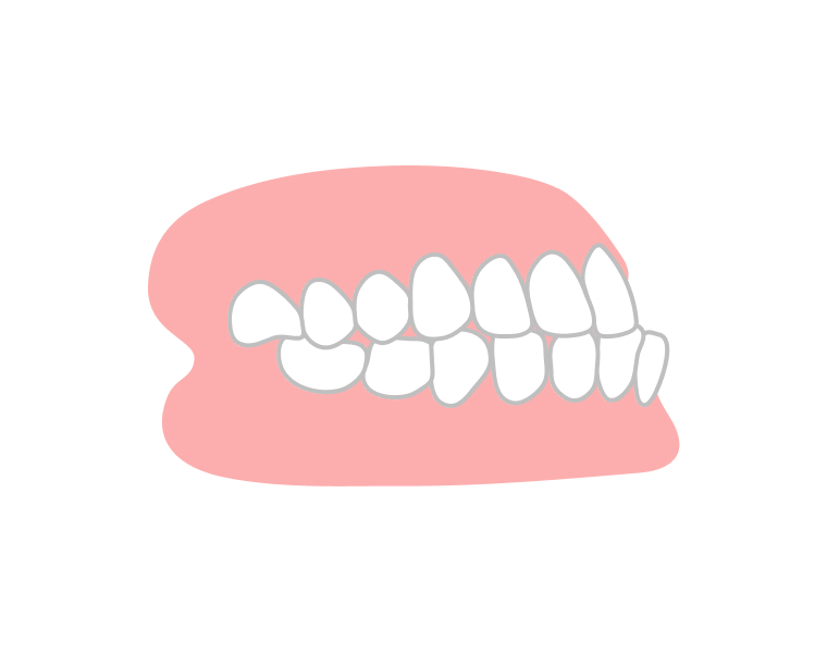 受け口が気になる