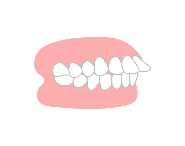 出っ歯で悩んでいる