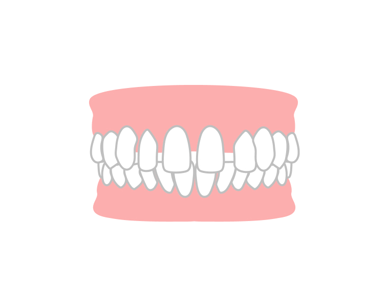すきっ歯を治したい