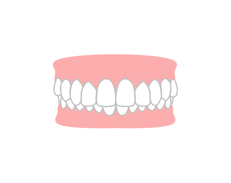 かみ合わせが悪い、合わない